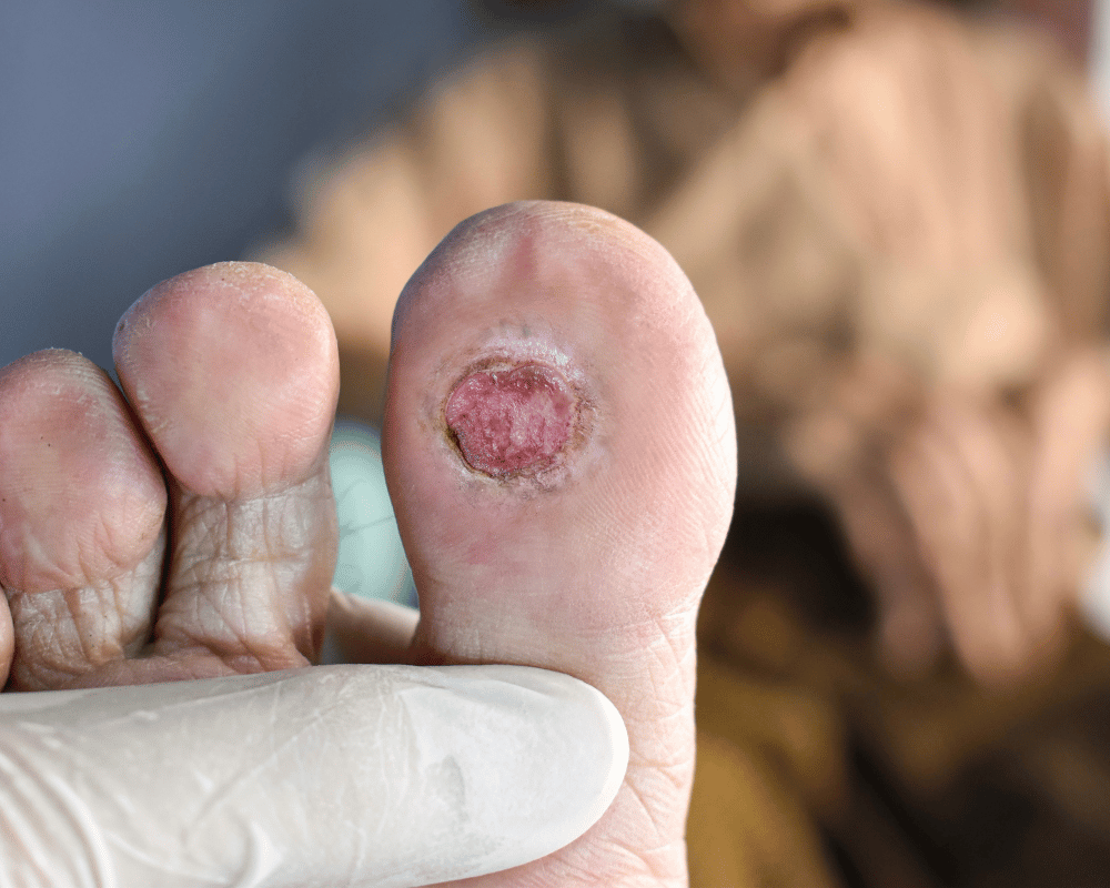 Cegah Luka Kaki Diabetes, Bagaimana Pencegahannya?